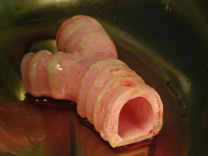 Traqueia Artificial em Vidro e Celulas-Tronco do Paciente